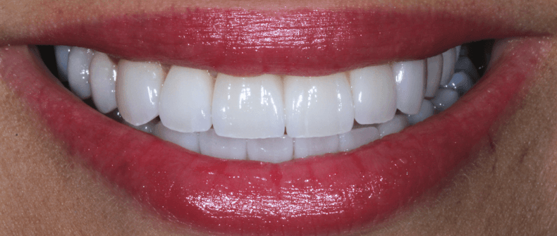 Smile after veneer treatment
