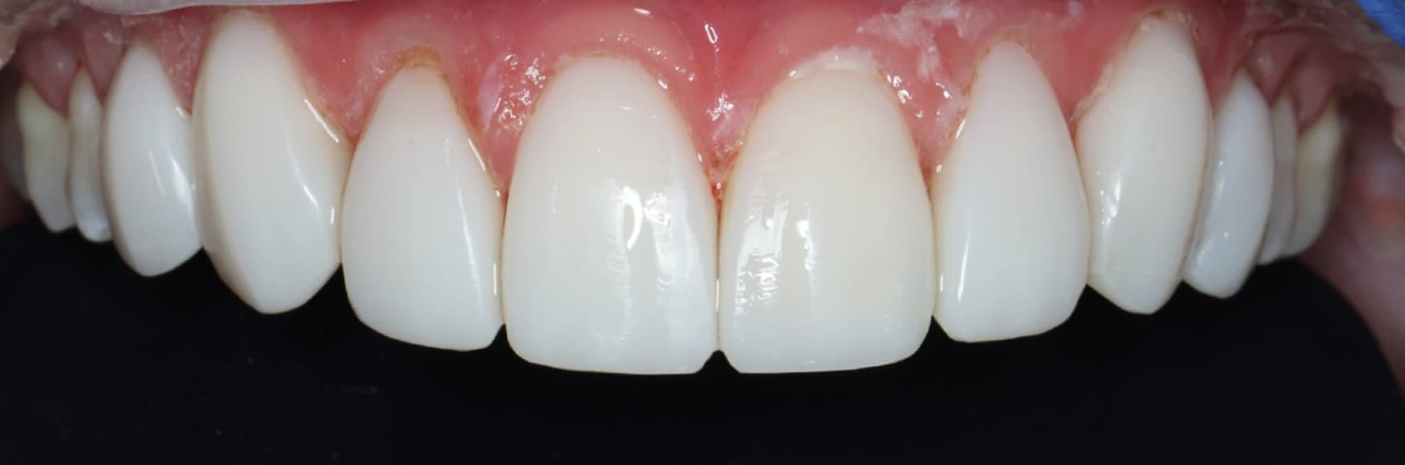 Smile after composite bonding treatment