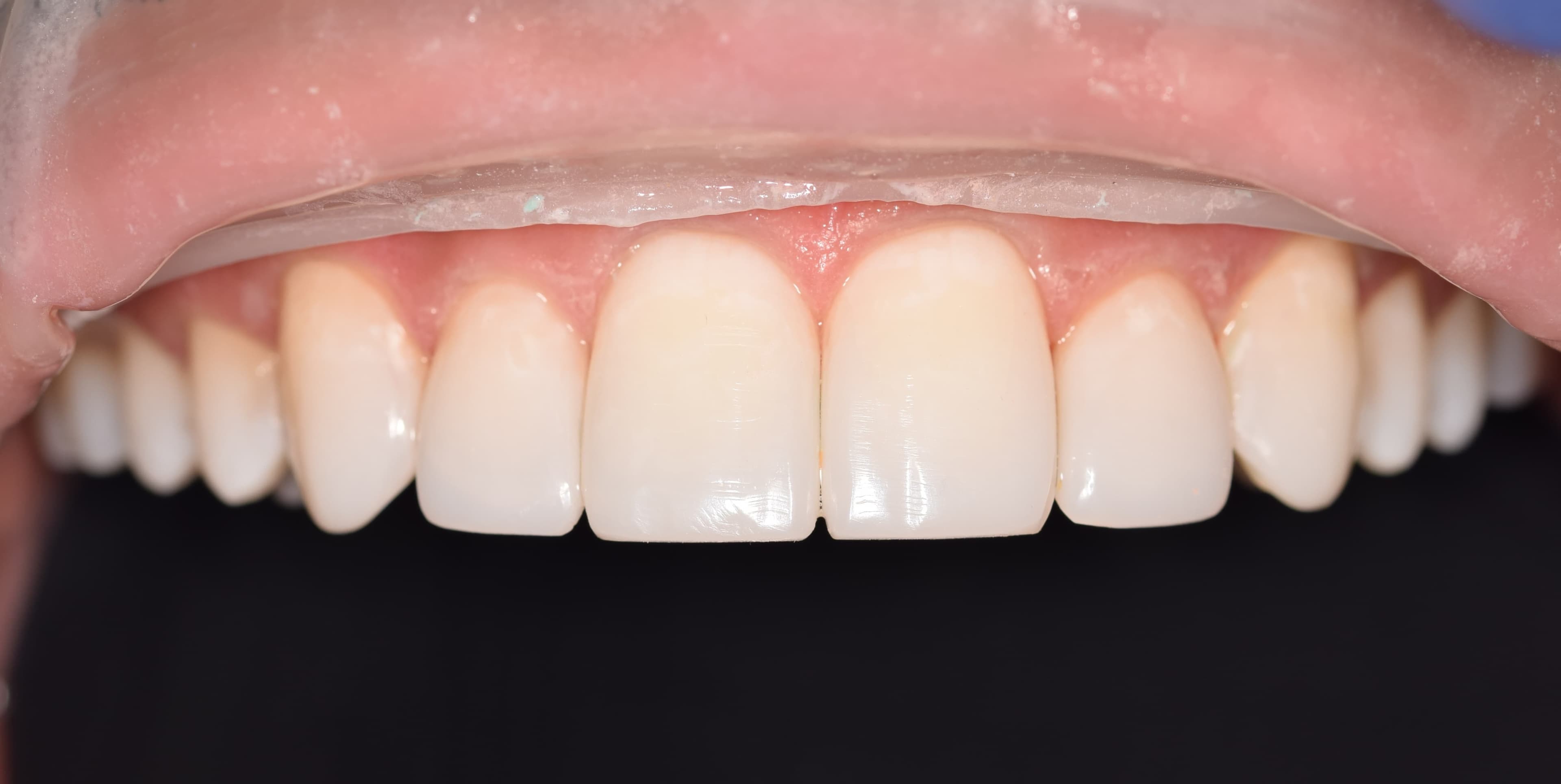 After composite bonding