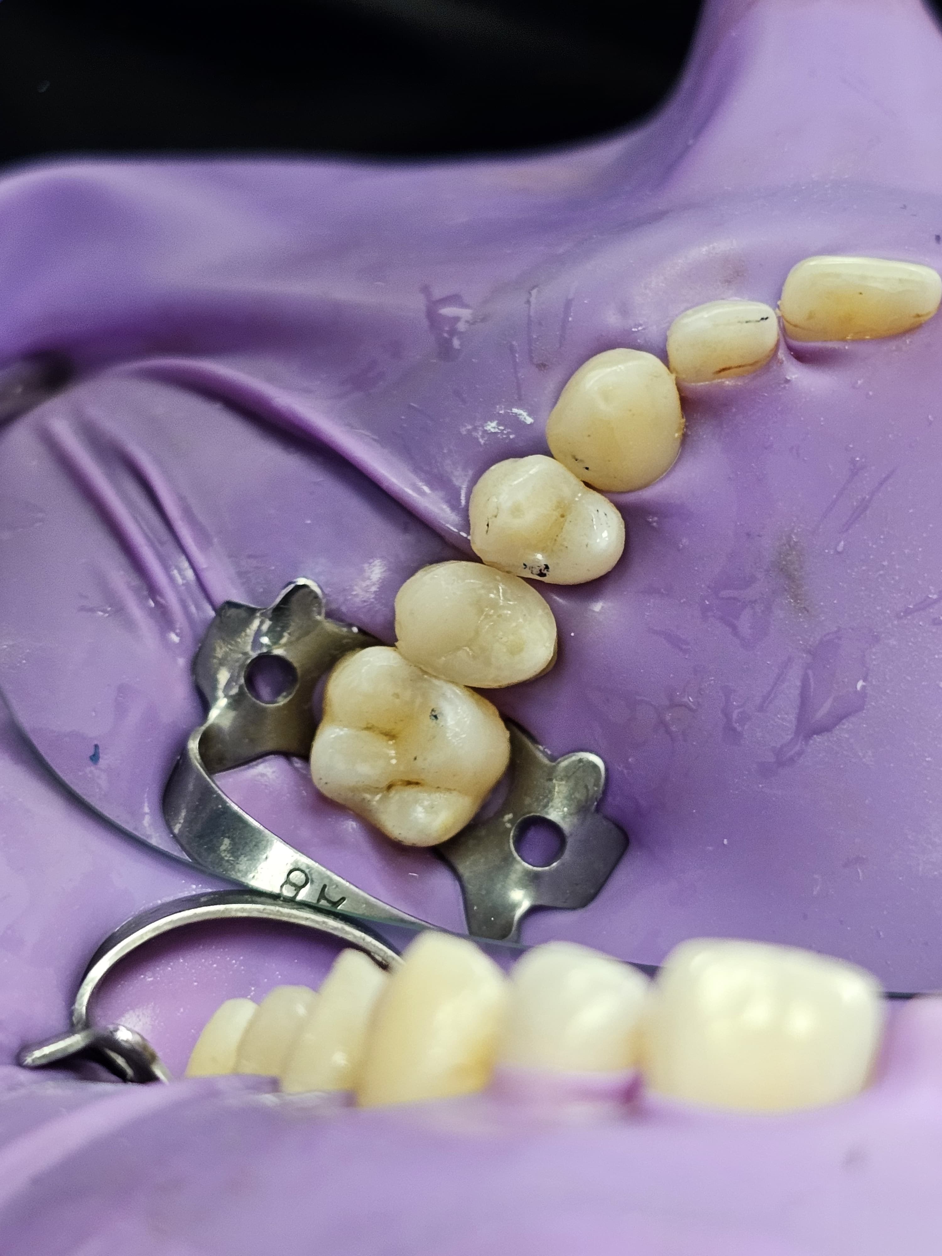 Teeth after direct composite bonding treatment