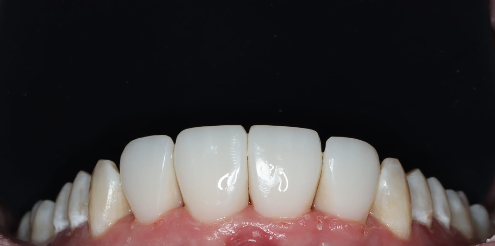 Teeth after dental gap closure treatment