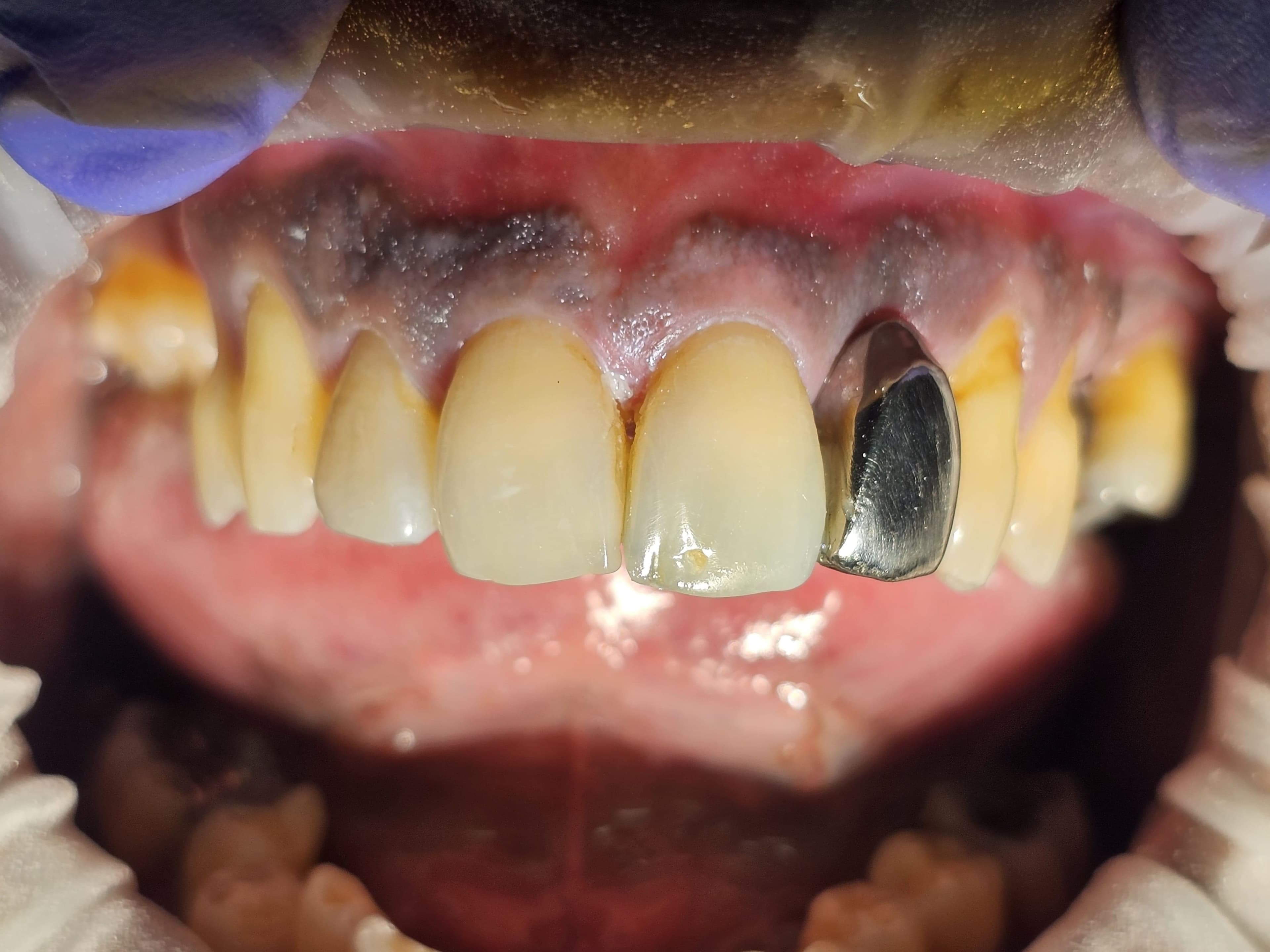 Smile after dental implant treatment