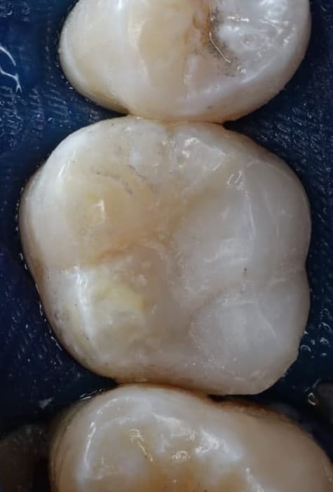 Teeth after root canal treatment