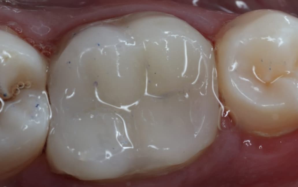 Tooth after root canal treatment