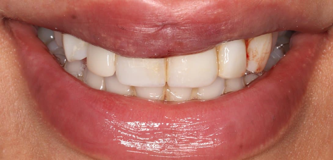 Smile after restorative dental treatment