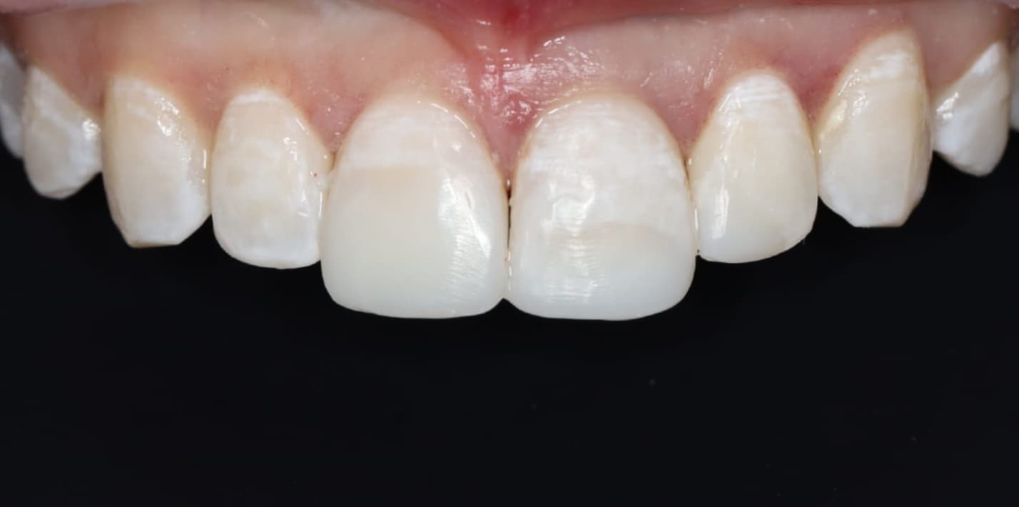 Teeth after dental trauma repair