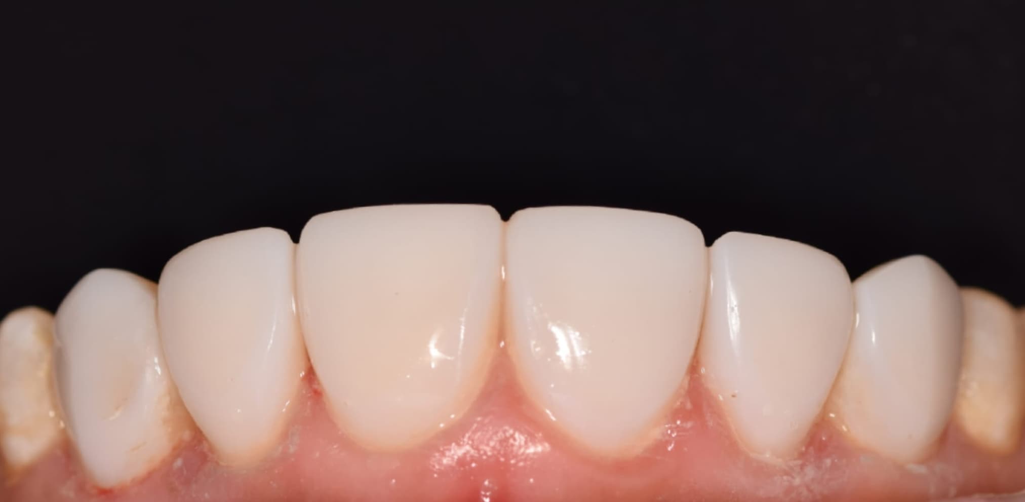 Teeth after whitening treatment