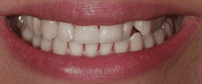 Smile before veneer treatment