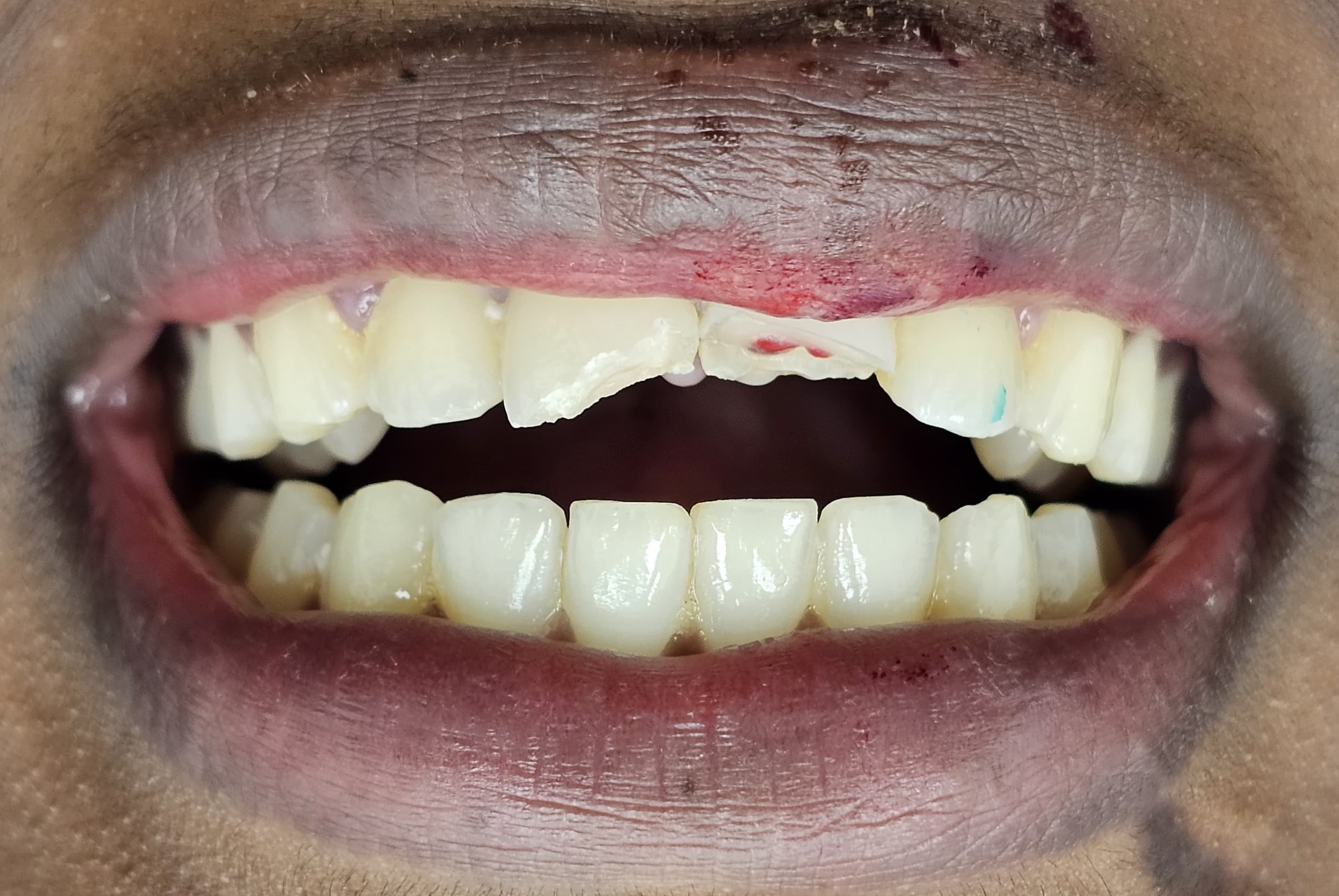Before emergency tooth repair
