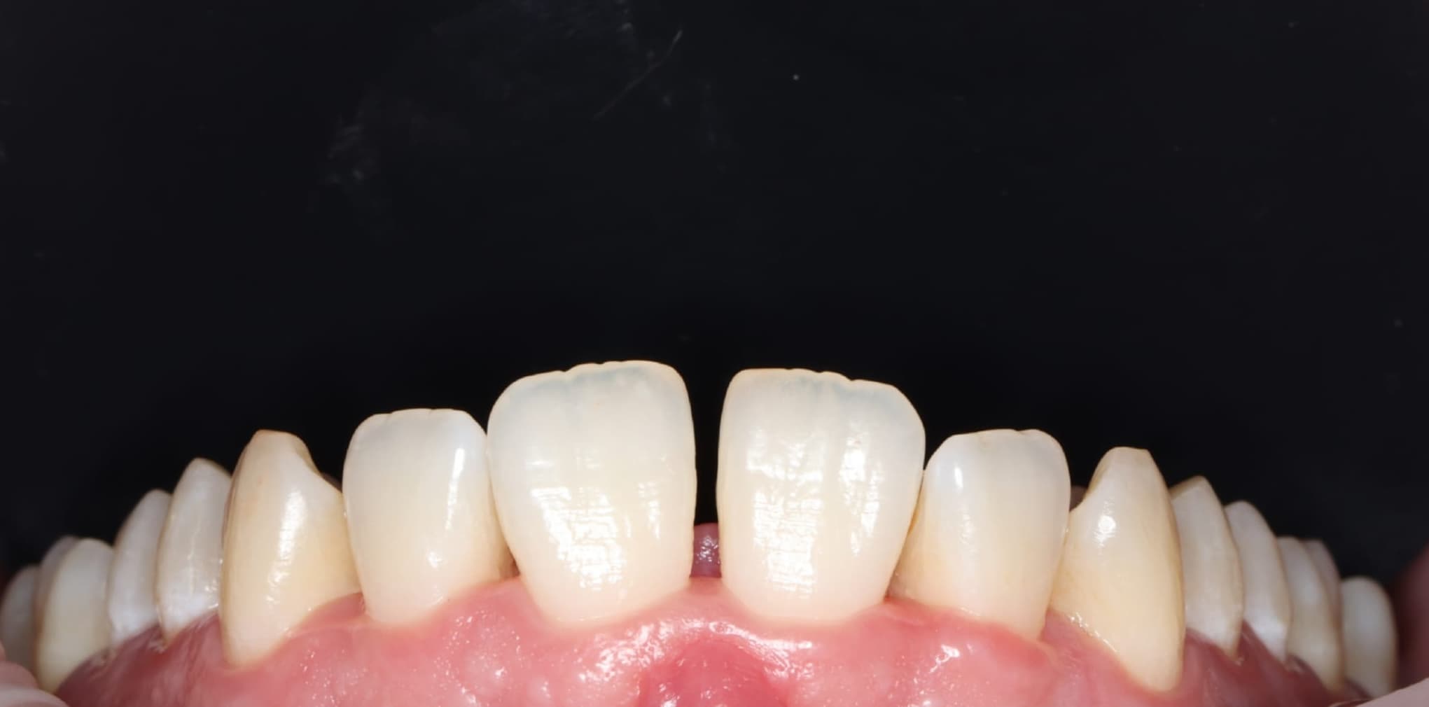 Teeth before dental gap closure treatment