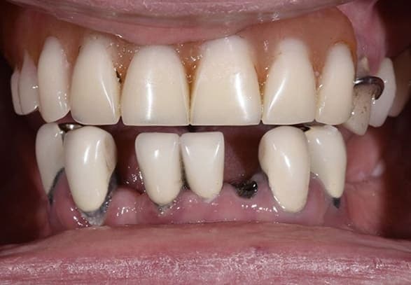 Teeth before dental implant treatment