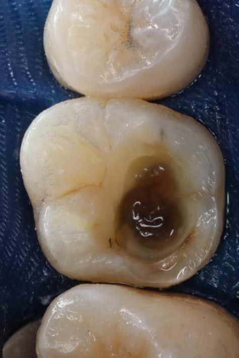 Teeth before root canal treatment