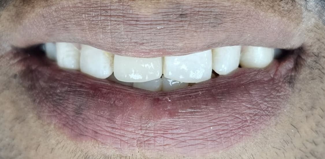 After porcelain veneer restoration