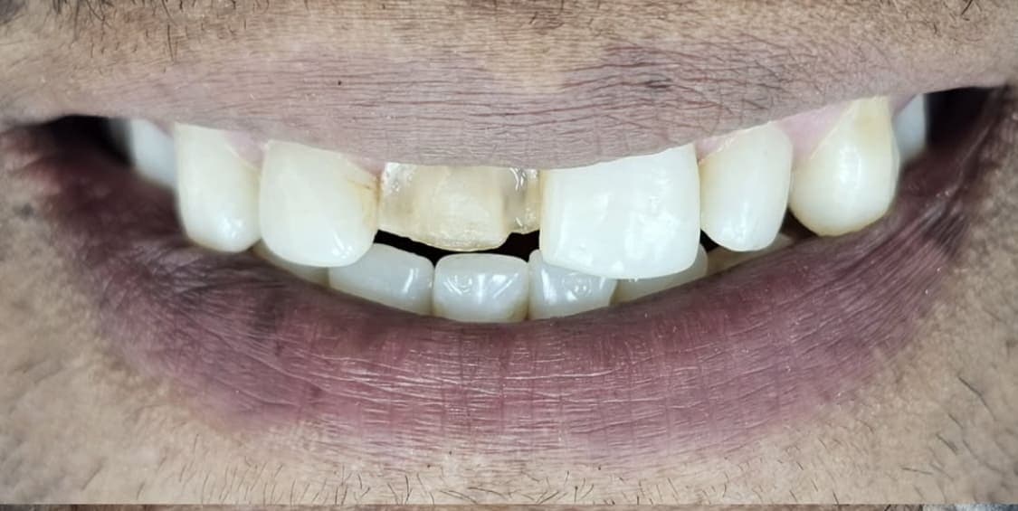 Before porcelain veneer restoration