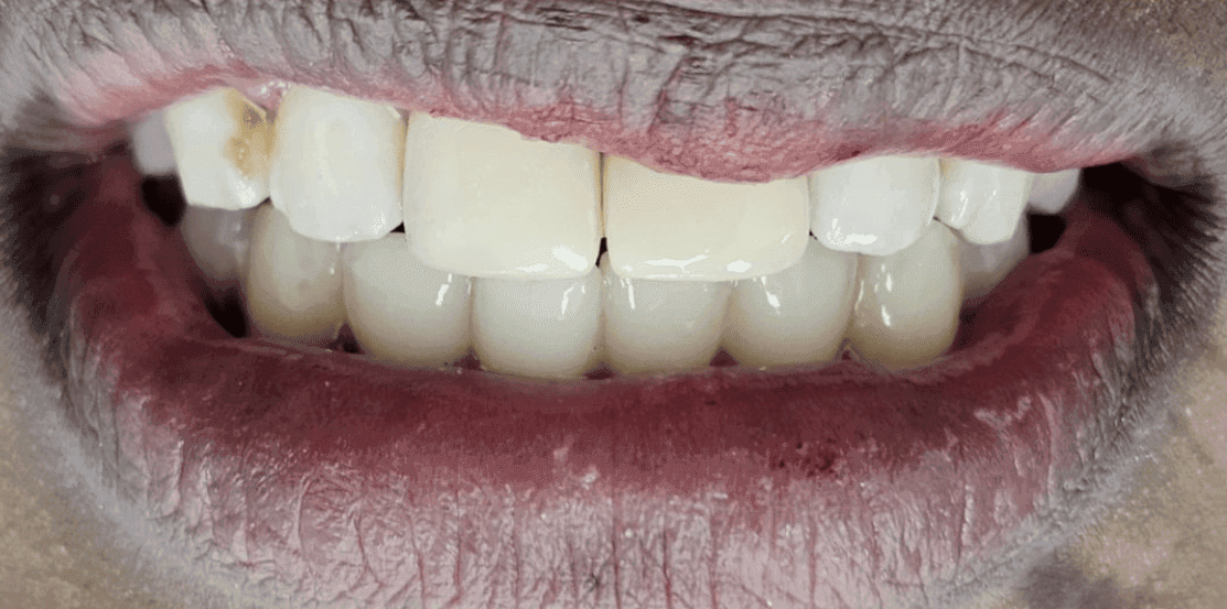 After emergency tooth repair