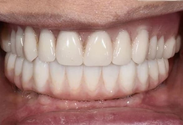Teeth after dental implant treatment