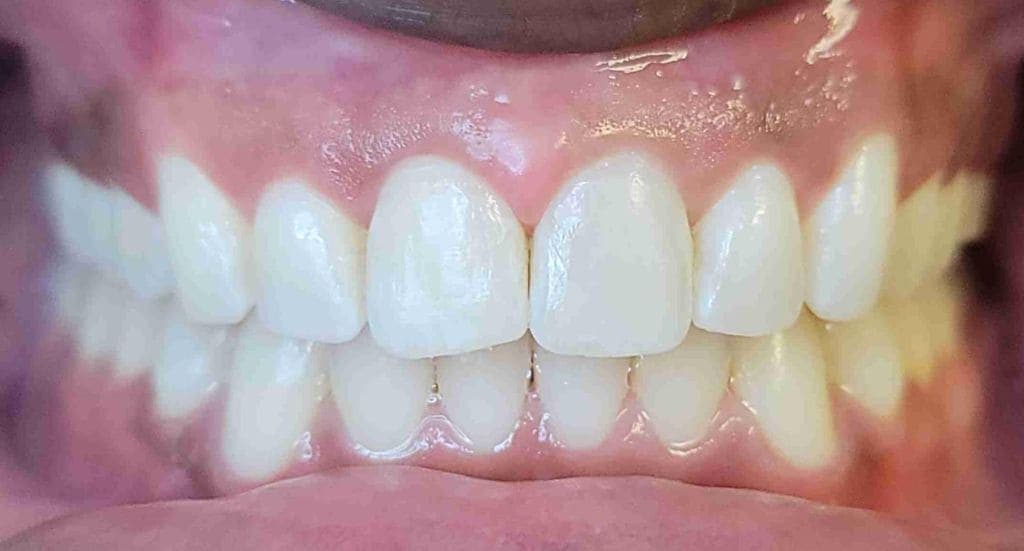 After invisalign treatment