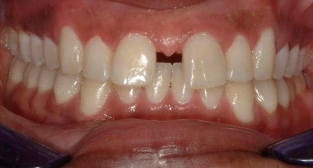 Before invisalign treatment