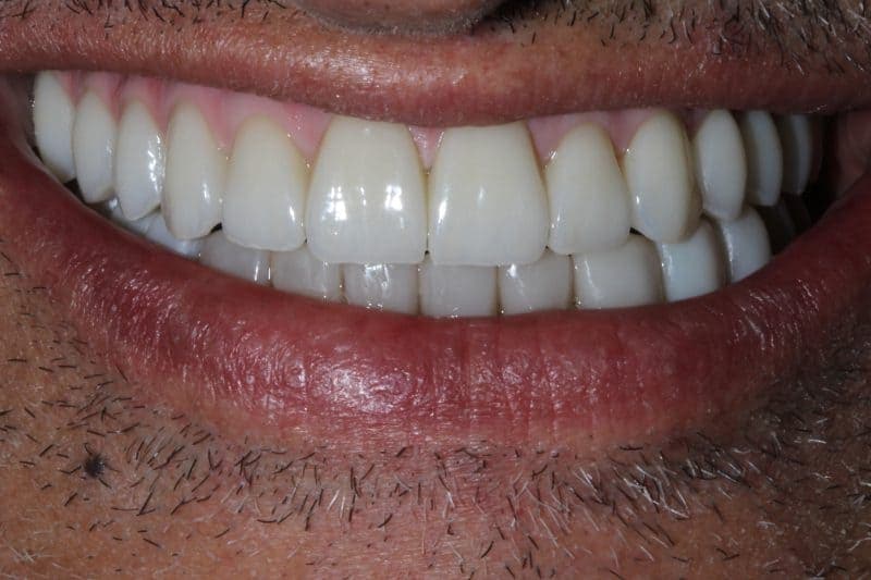 After full-arch dental implant treatment