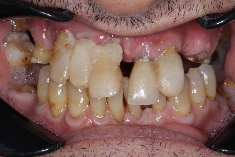 Before full-arch dental implant treatment