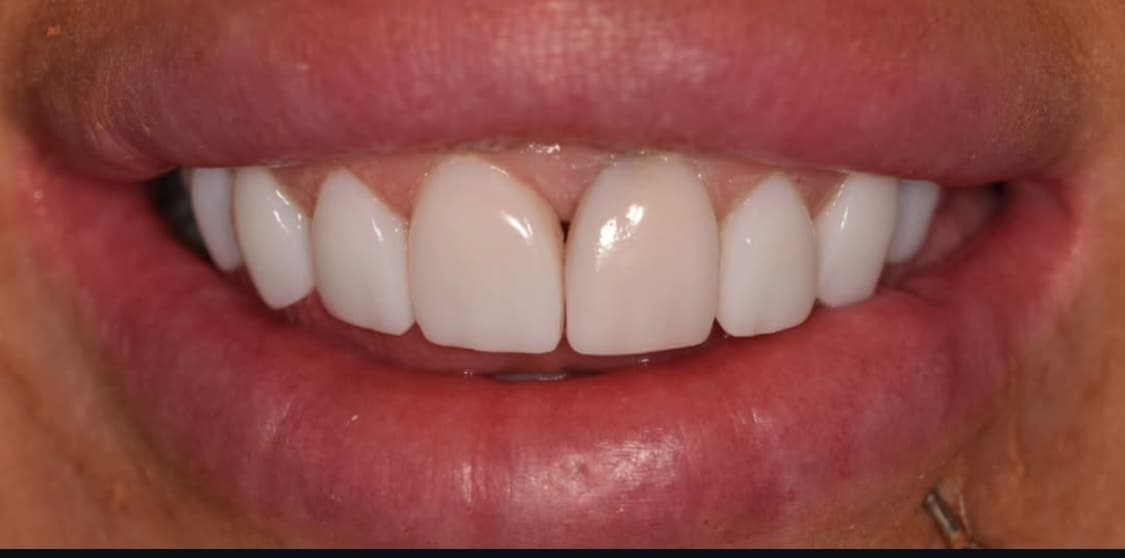After cosmetic smile makeover treatment