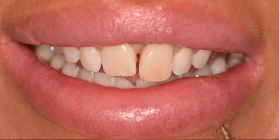 Before cosmetic smile makeover treatment