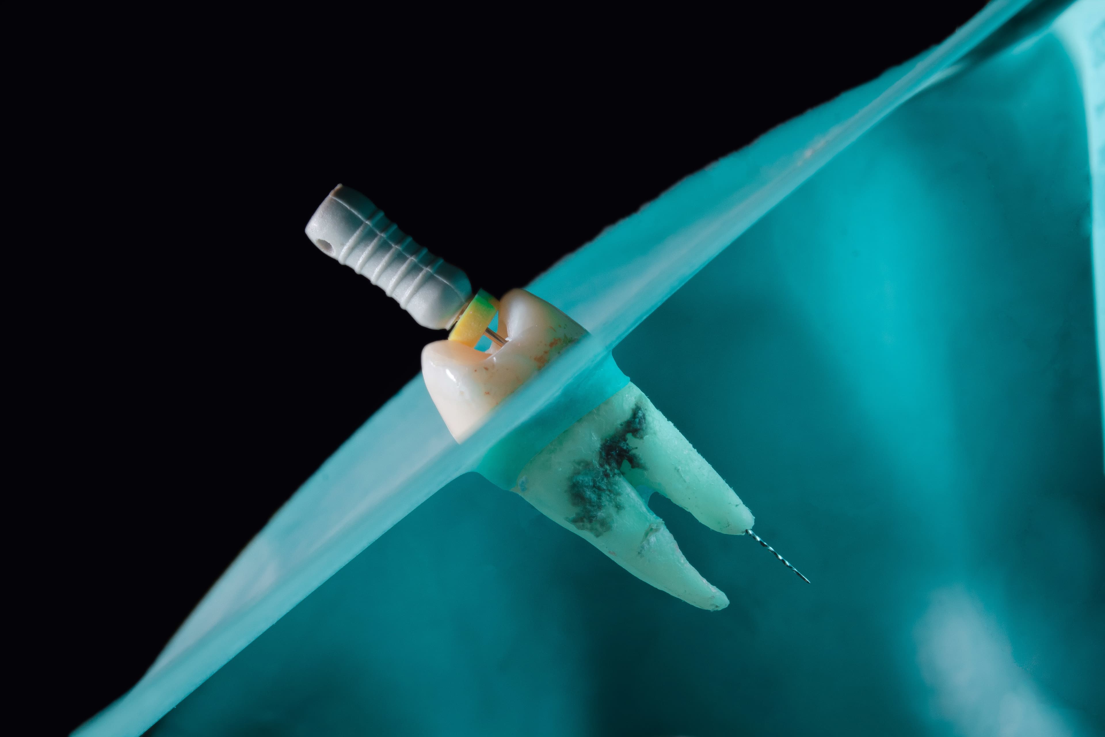 Dentist carrying out root canal treatment