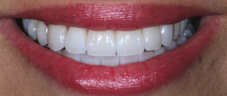 Smile after veneer treatment