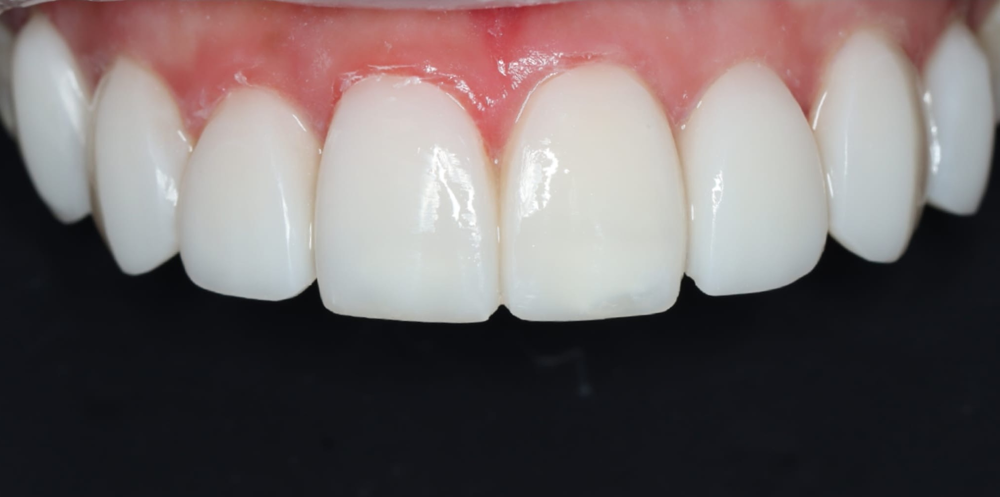 Teeth after composite bonding treatment