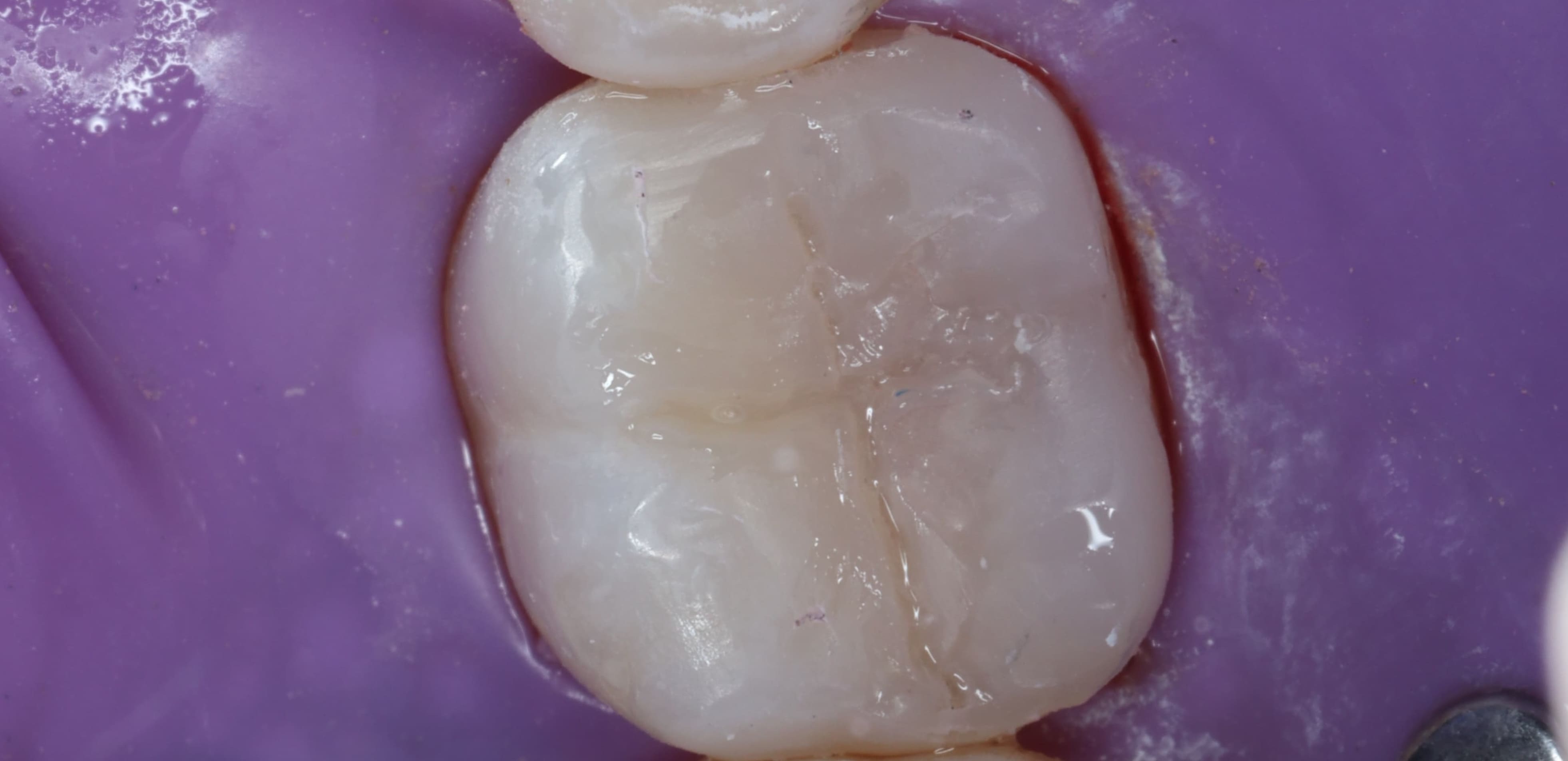 Smile after direct composite bonding treatment