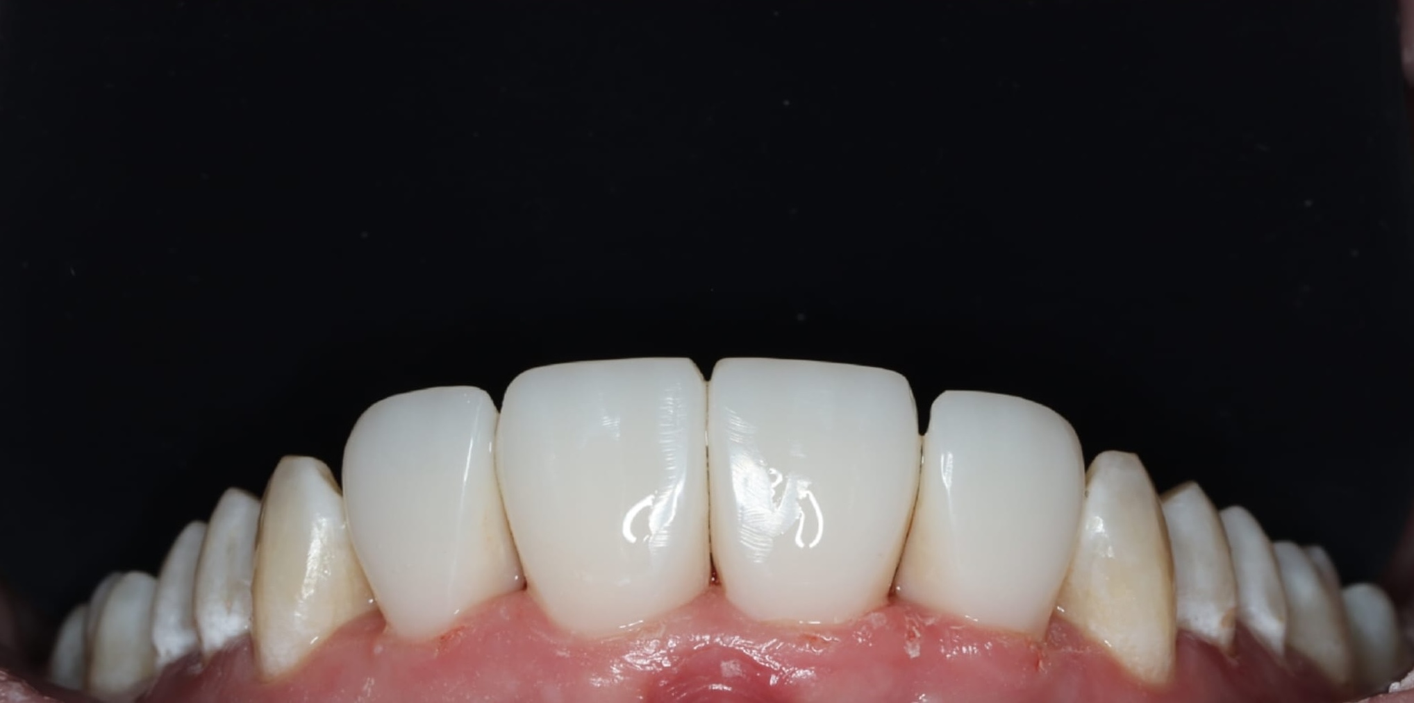 Teeth after dental gap closure treatment