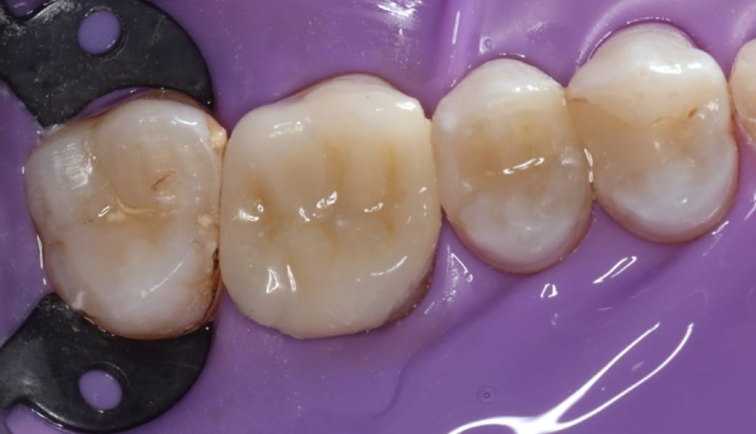 Tooth after root canal treatment