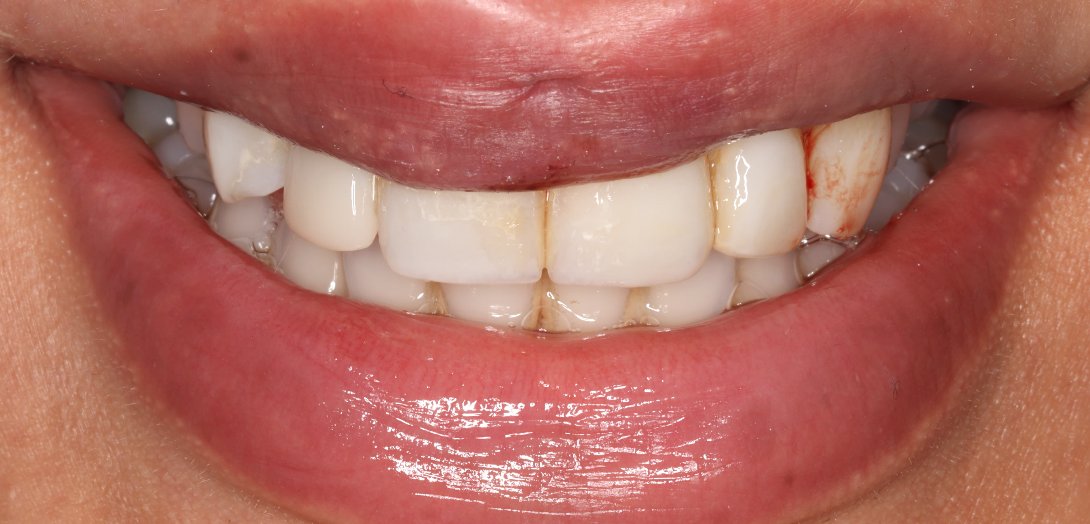 Smile after restorative dental treatment
