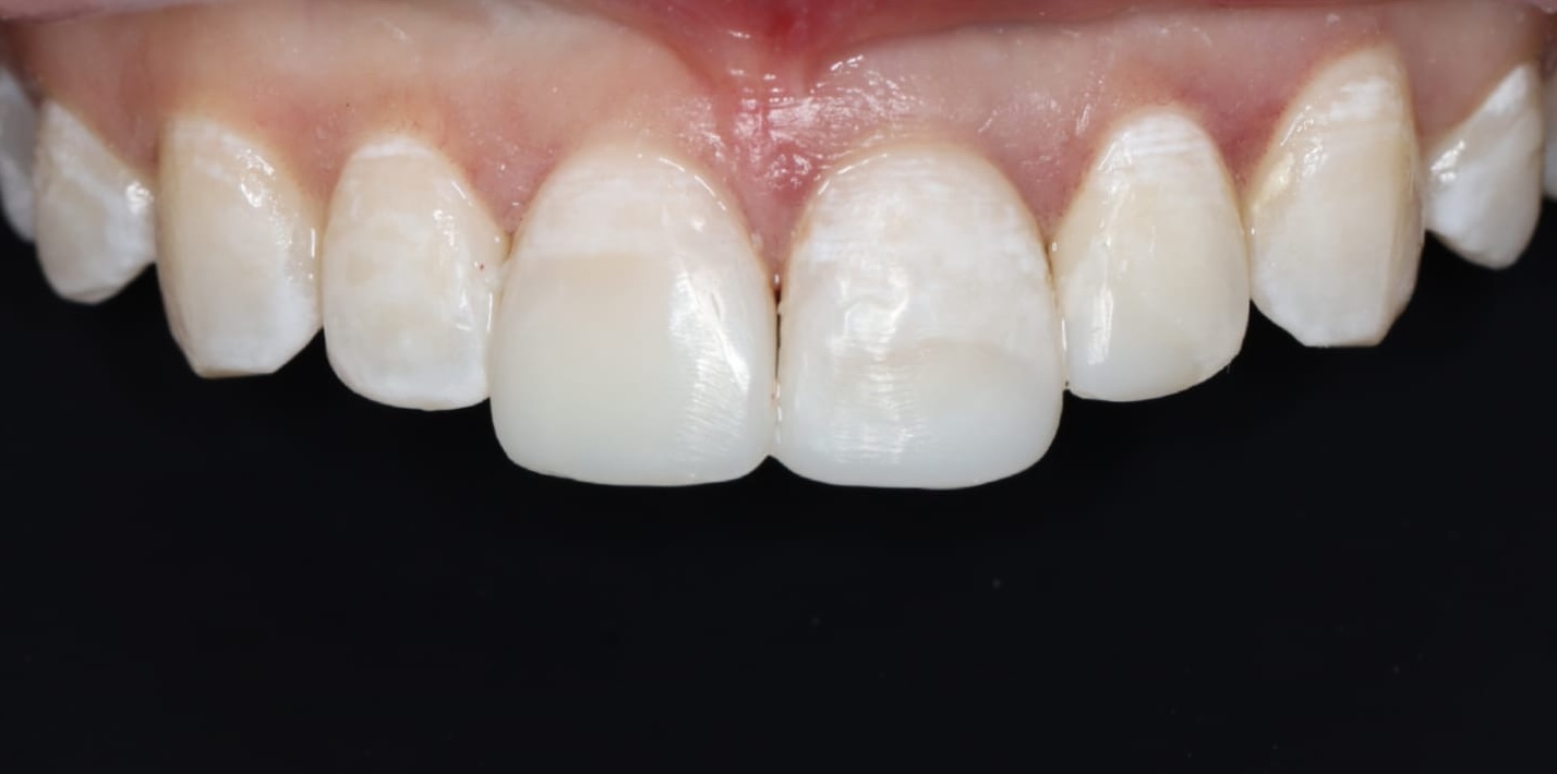 Teeth after dental trauma repair