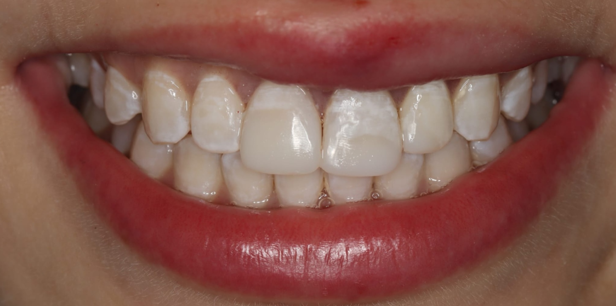 Smile after dental trauma repair