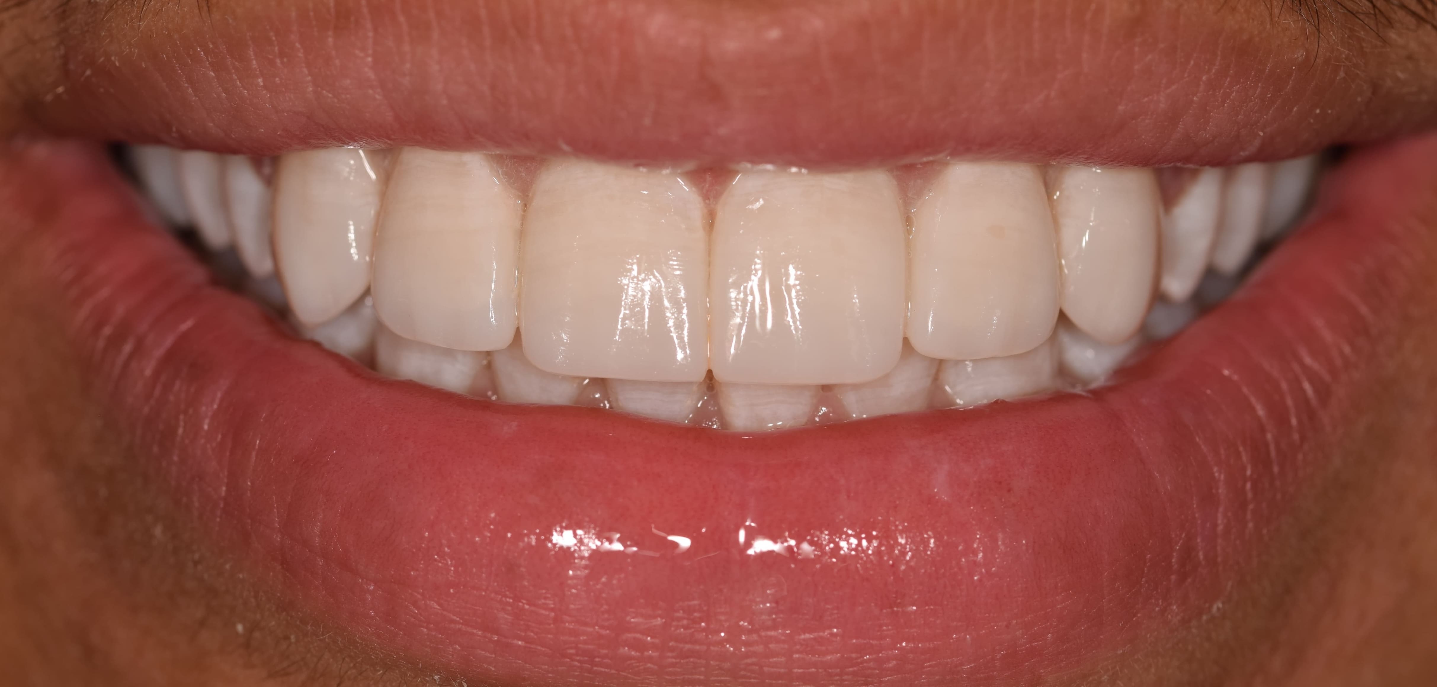 Teeth after veneer treatment