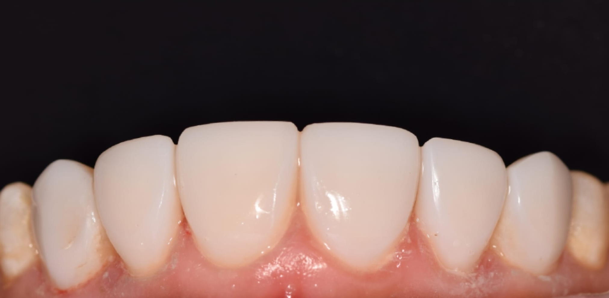 Teeth after whitening treatment