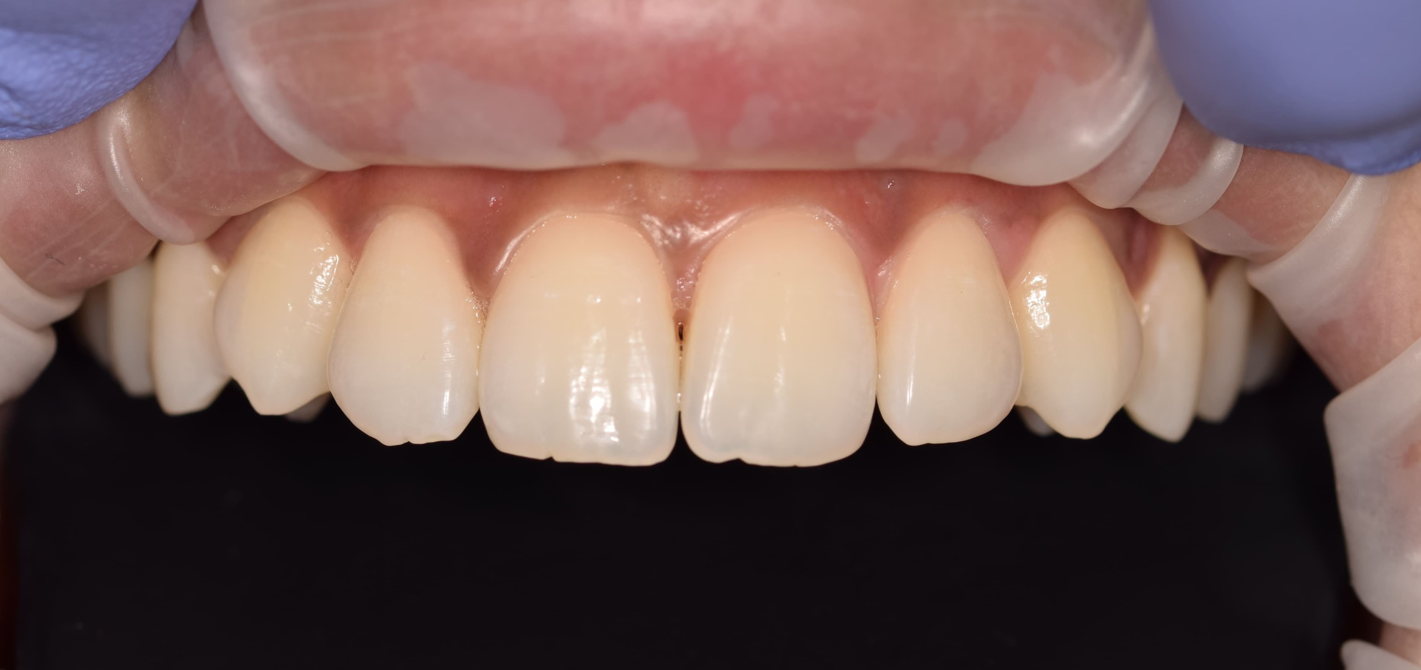 Smile before composite bonding treatment