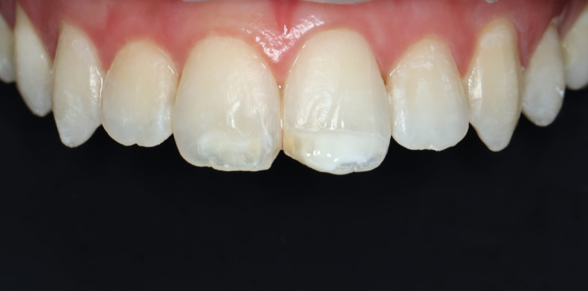 Teeth before composite bonding treatment