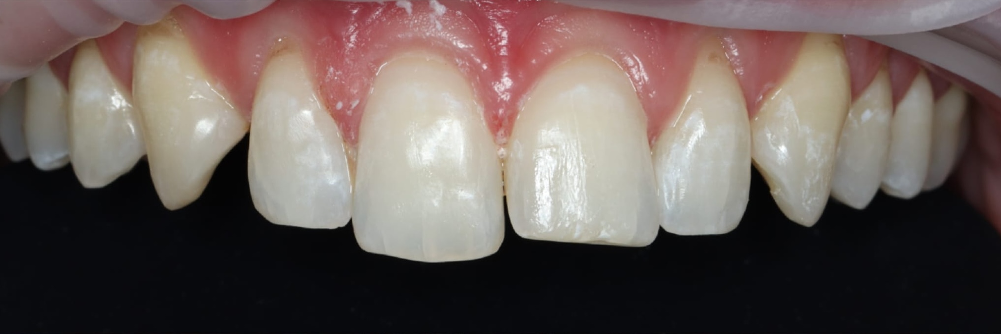 Smile before composite bonding treatment