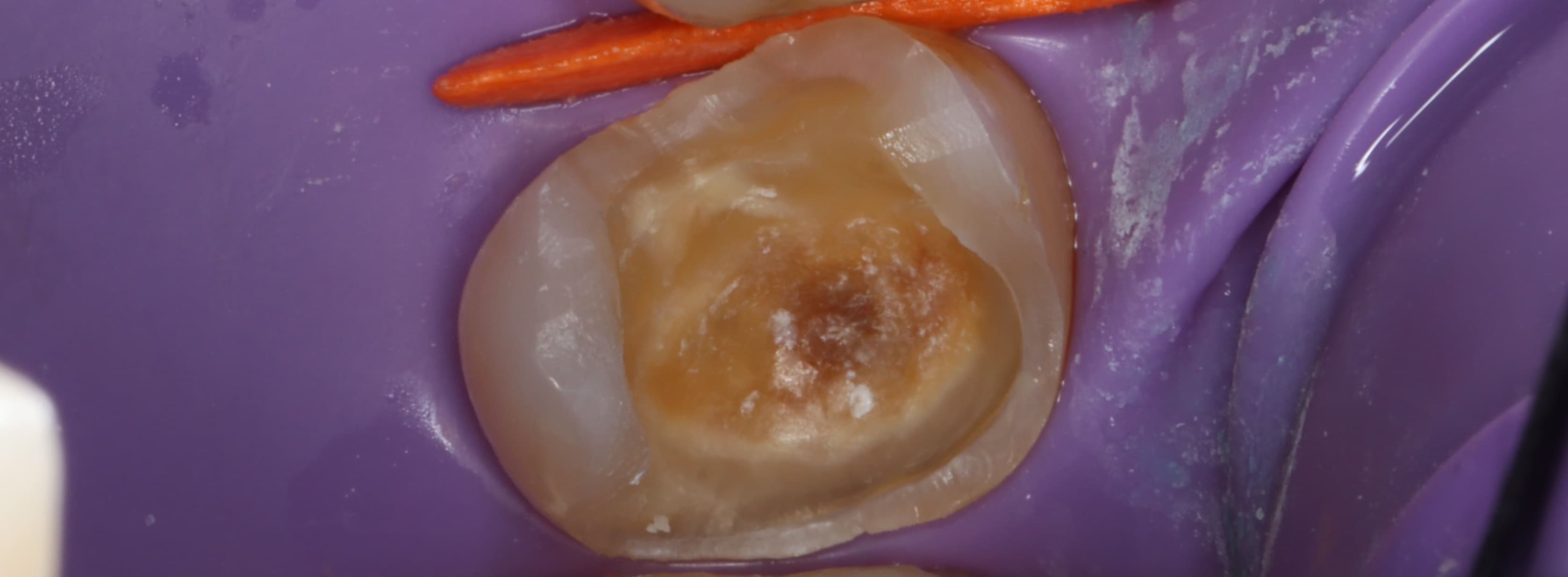 Teeth before direct composite bonding treatment