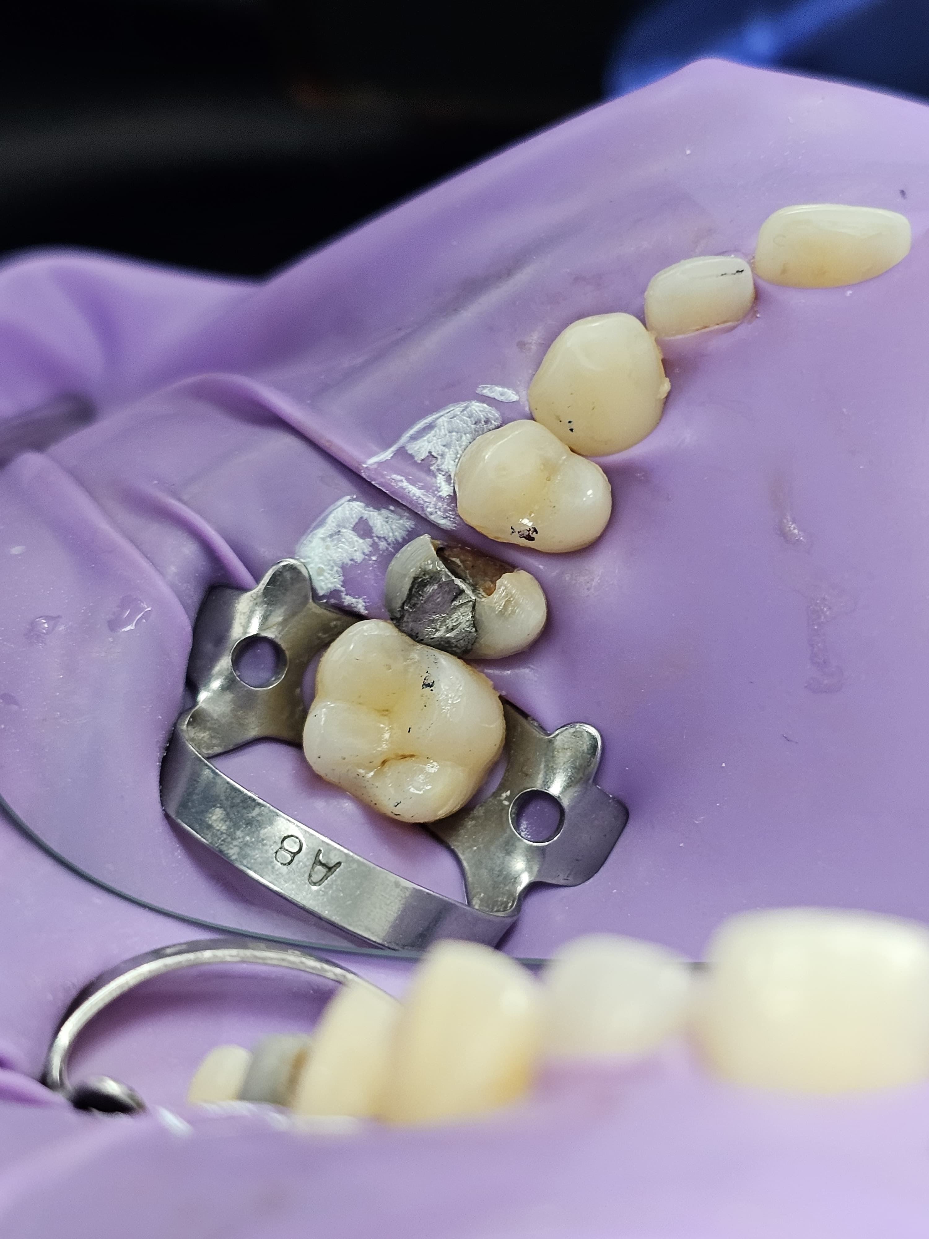 Smile before direct composite bonding treatment