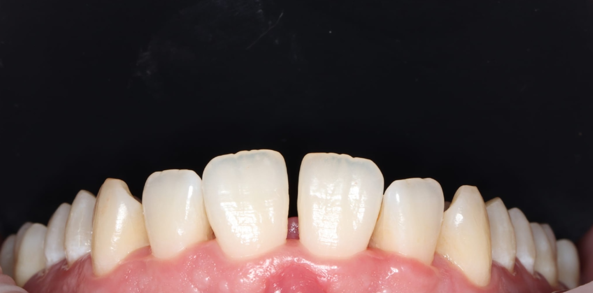 Teeth before dental gap closure treatment