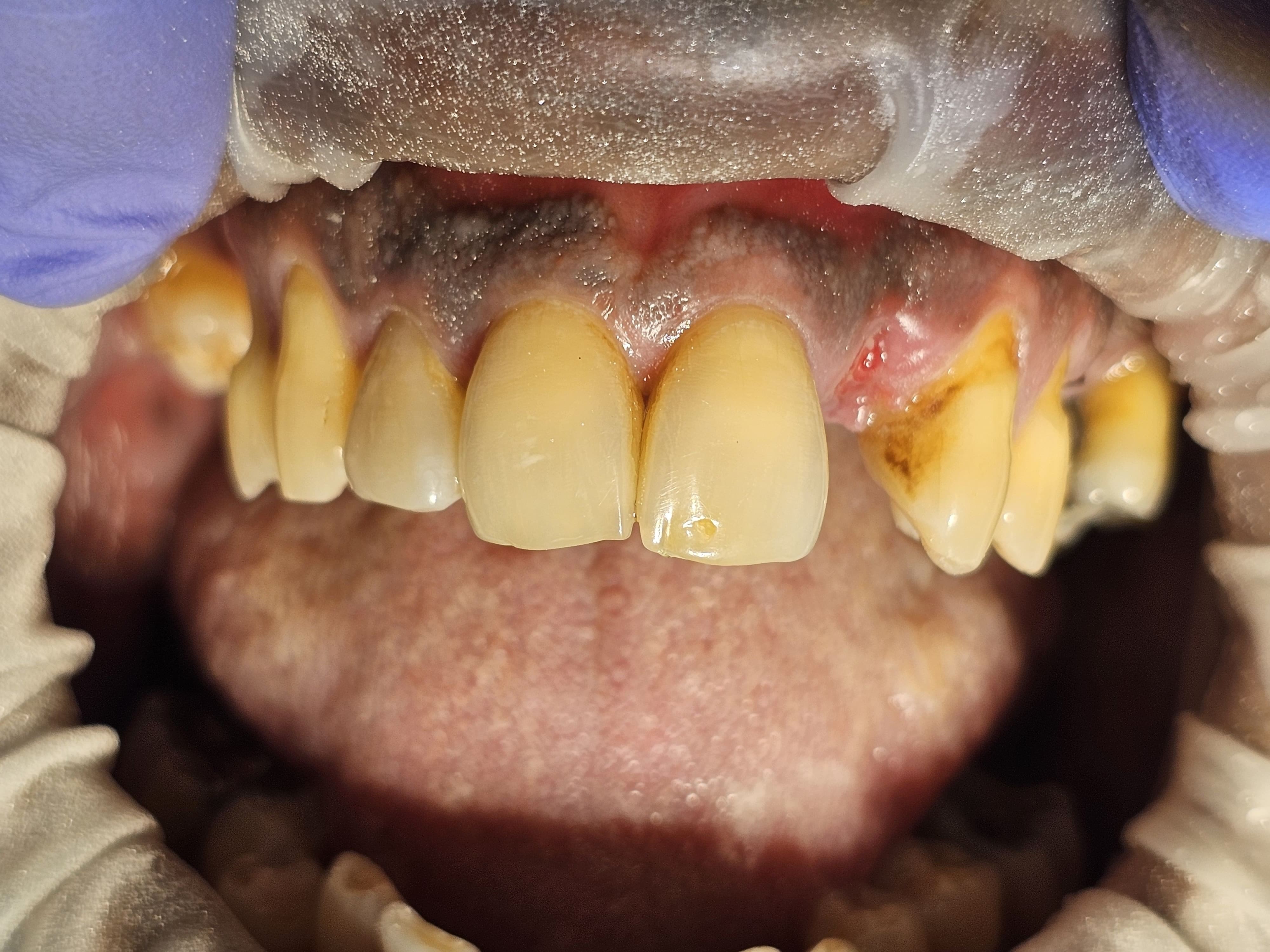 Smile before dental implant treatment
