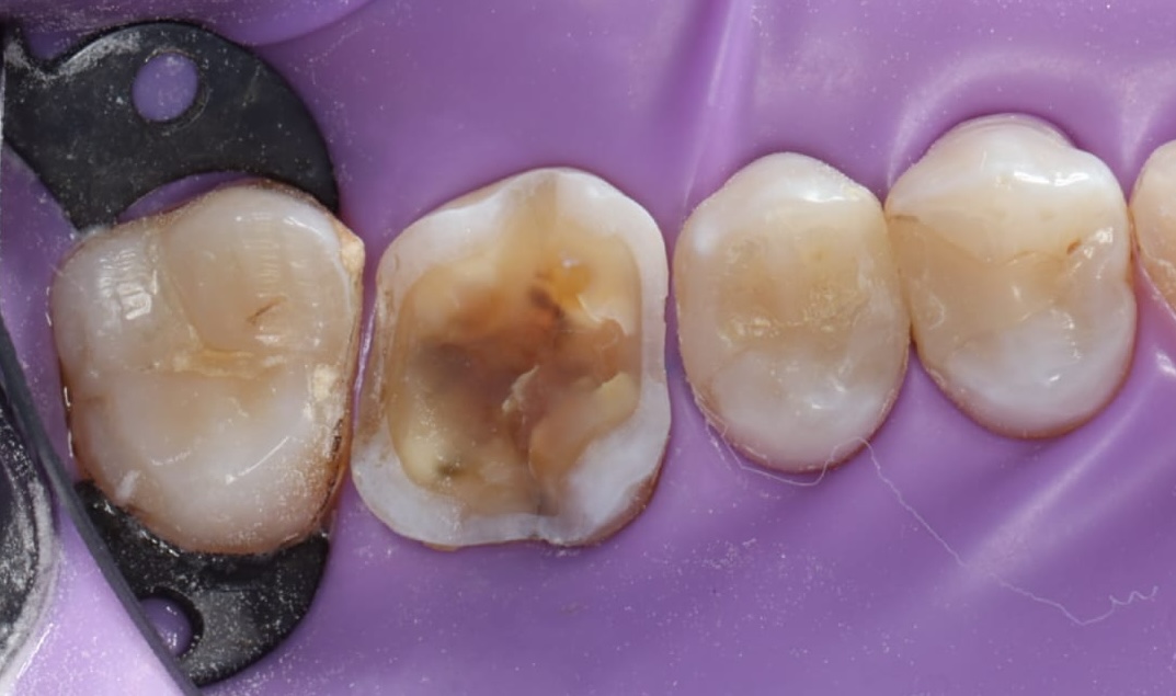 Tooth before root canal treatment