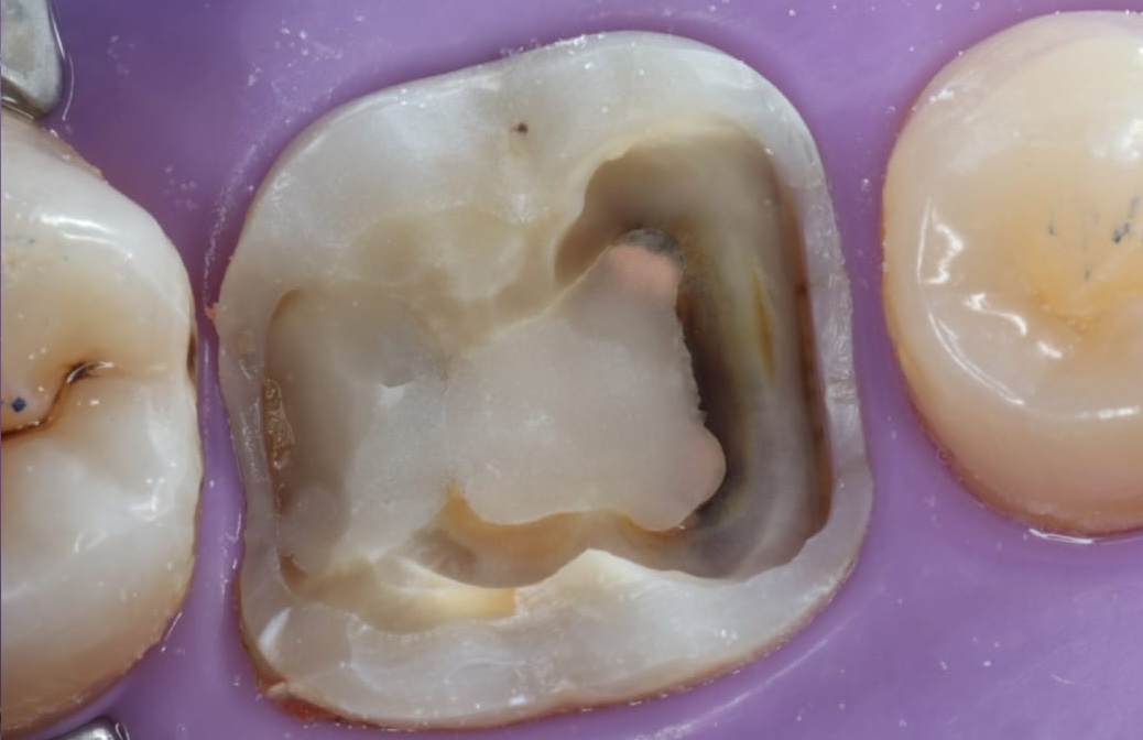 Tooth before root canal treatment