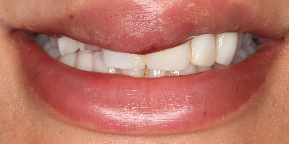 Smile before restorative dental treatment