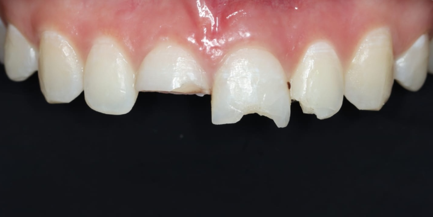 Teeth before dental trauma repair