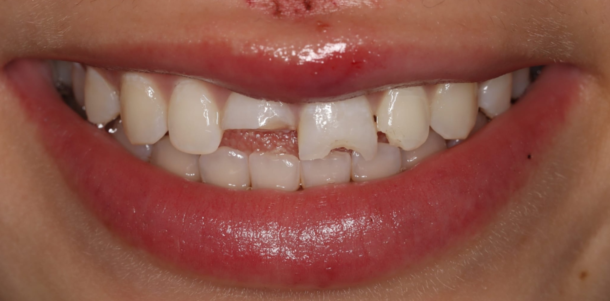 Smile before dental trauma repair