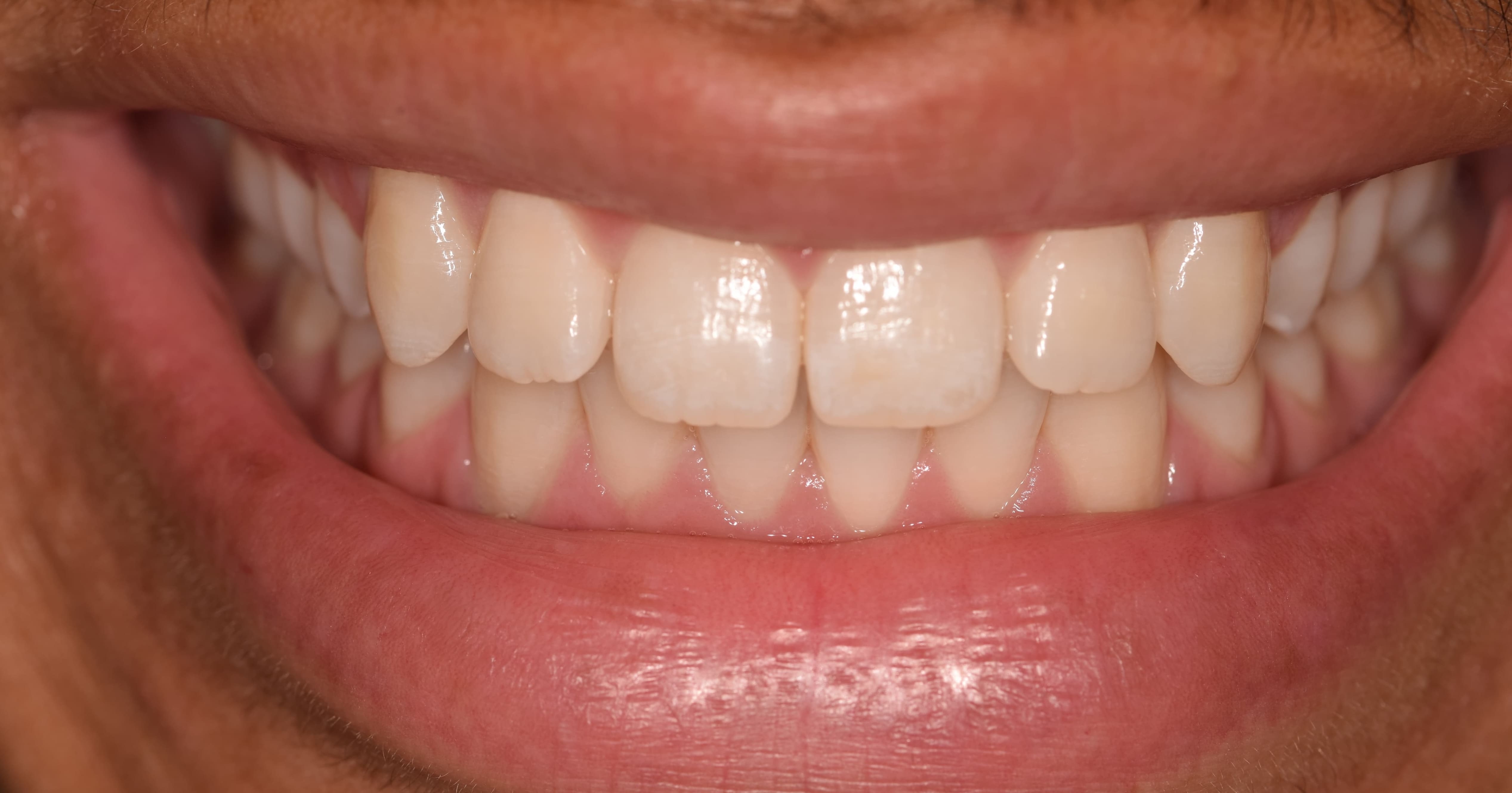 Teeth before veneer treatment